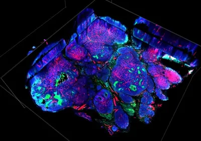 Histological stain of in blue, red, and green of tumor